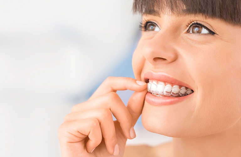 invisalign clear aligners