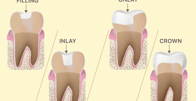 how dental fillings compare to inlays and onlays