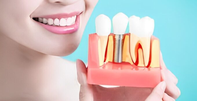 reasons to considering dental implants