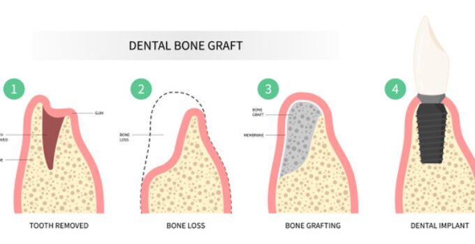 understanding dental bone grafts